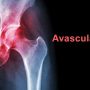 Avascular Necrosis - Mayfair Wellness Clinic Gulshan