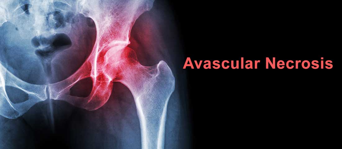 Avascular Necrosis - Mayfair Wellness Clinic Gulshan