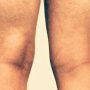 Bakers Cyst Knee 1 - Mayfair Wellness Clinic Gulshan
