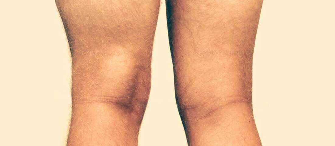 Bakers Cyst Knee 1 - Mayfair Wellness Clinic Gulshan