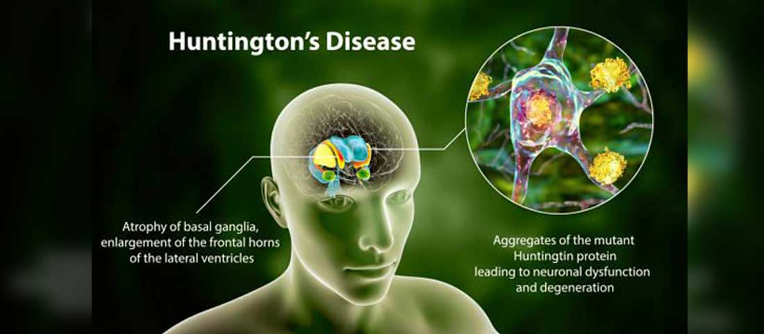 Huntingtons Disease - Mayfair Wellness Clinic Gulshan