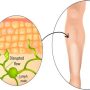 Lymphedema - Mayfair Wellness Clinic Gulshan