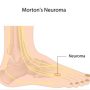 MORTONS NEUROMA - Mayfair Wellness Clinic Gulshan