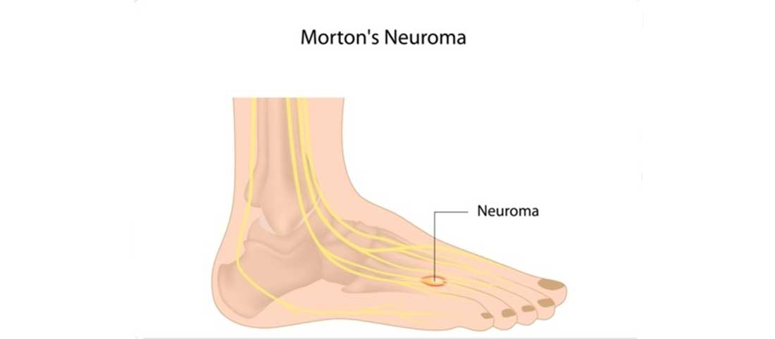 MORTONS NEUROMA - Mayfair Wellness Clinic Gulshan