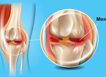Meniscus Tear - Mayfair Wellness Clinic Gulshan