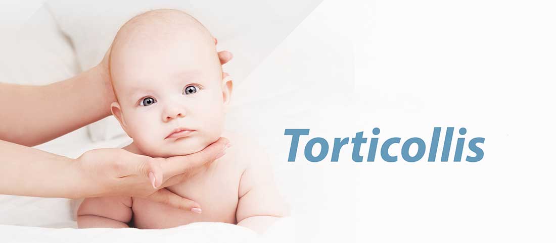 Torticollis - Mayfair Wellness Clinic Gulshan