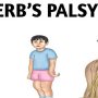 Erb Palasy - Mayfair Wellness Clinic Gulshan