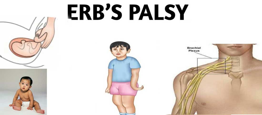 Erb Palasy - Mayfair Wellness Clinic Gulshan