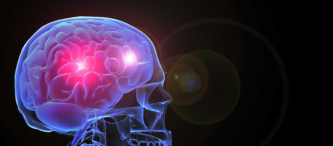 Motor Neuron Deasis Bg - Mayfair Wellness Clinic Gulshan