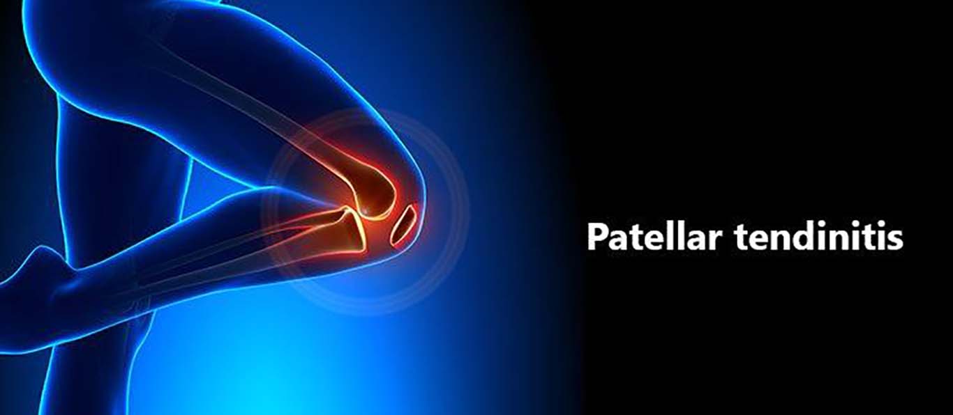 Patellar Tendinitis - Mayfair Wellness Clinic Gulshan