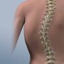 Scoliosis - Mayfair Wellness Clinic Gulshan
