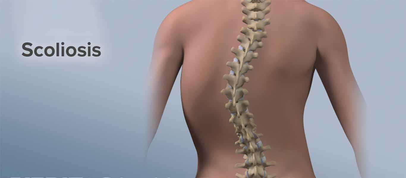 Scoliosis - Mayfair Wellness Clinic Gulshan