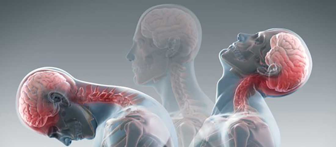 Whiplash Injury - Mayfair Wellness Clinic Gulshan