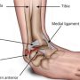 Ankle Sprain - Mayfair Wellness Clinic Gulshan