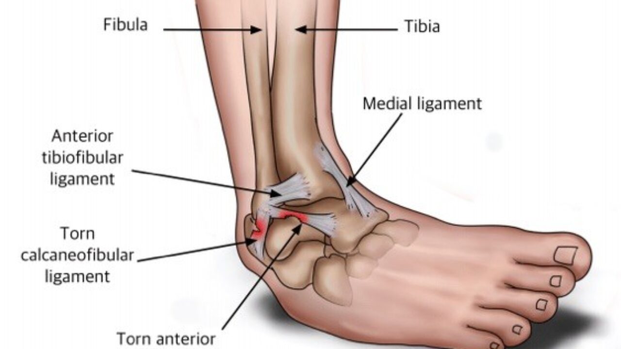 Ankle Sprain - Mayfair Wellness Clinic Gulshan