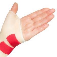 De Quervain’s Tenosynovitis 3 De Quervains1 De Quervain’s Tenosynovitis