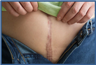 Hysterectomy 4 Hysterectomy2 Hysterectomy