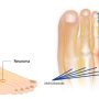 MORTON'S NEUROMA - Mayfair Wellness Clinic Gulshan