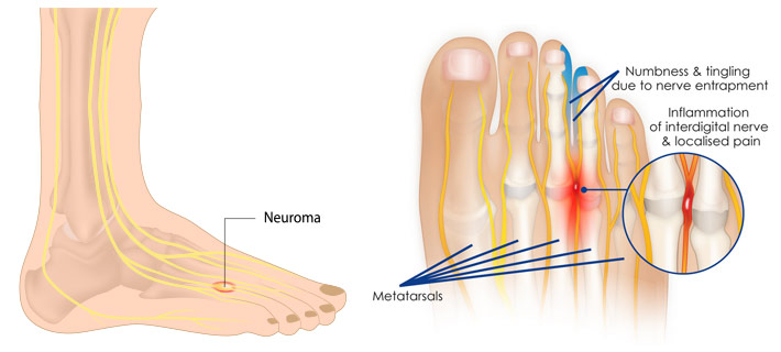 MORTON'S NEUROMA - Mayfair Wellness Clinic Gulshan