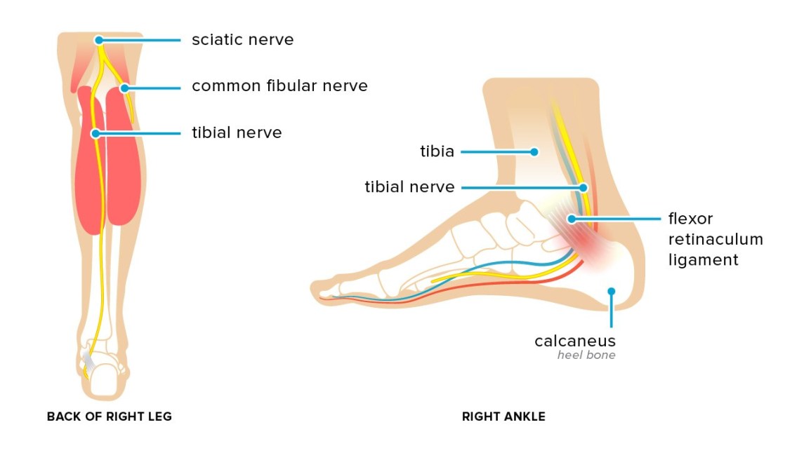Tarsal Tunnel Syndrome - Mayfair Wellness Clinic Gulshan