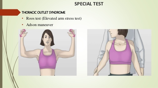 Thoracic Outlet Syndrome 4 Thoracic Outlet Syndrome1 Thoracic Outlet Syndrome