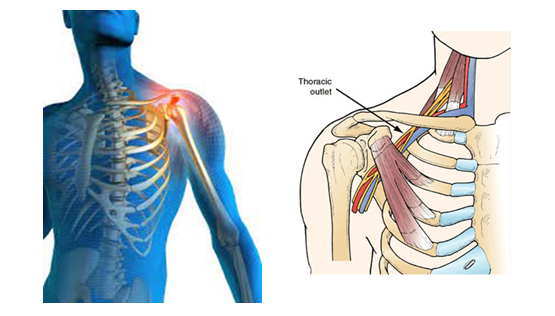 Thoracic Outlet Syndrome 3 Thoracic Outlet Syndrome9 Thoracic Outlet Syndrome