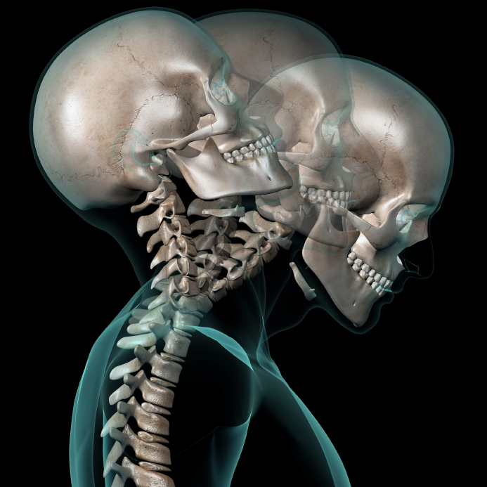 Whiplash Injury - Mayfair Wellness Clinic Gulshan