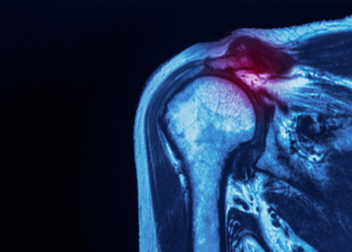 SLAP Tear - Mayfair Wellness Clinic Gulshan