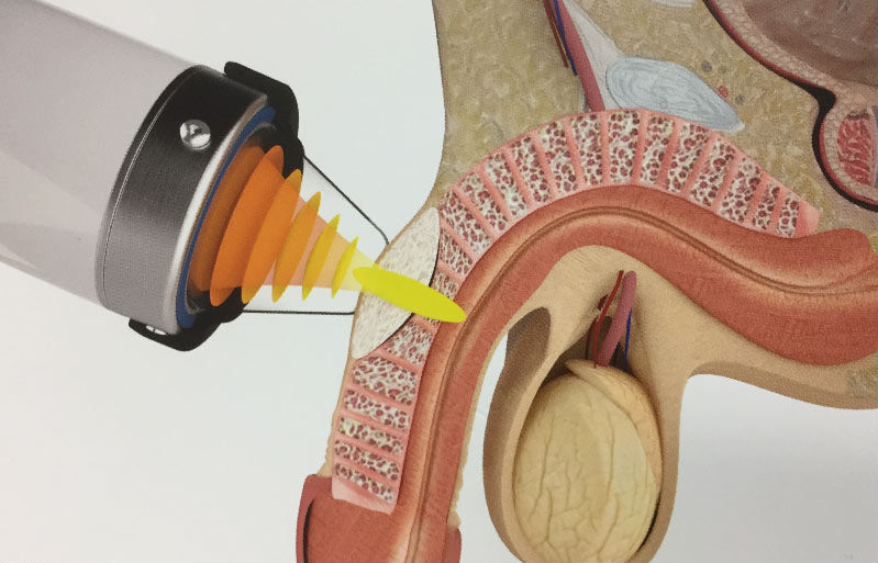 Hormones Peyronies Disease Erect - Mayfair Wellness Clinic Gulshan